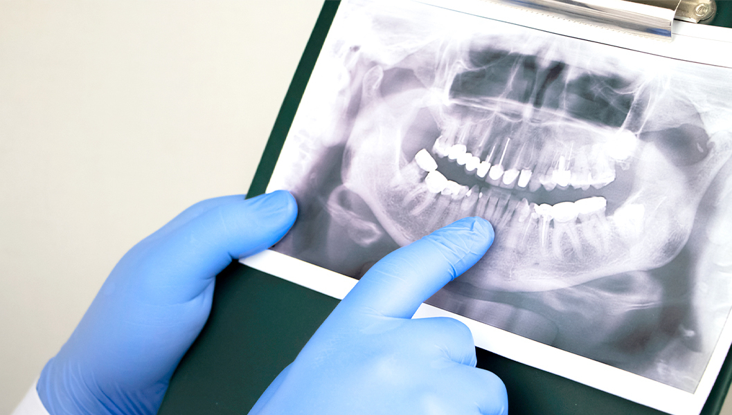 天神・福岡市中央区のなるべく神経を抜かない治療