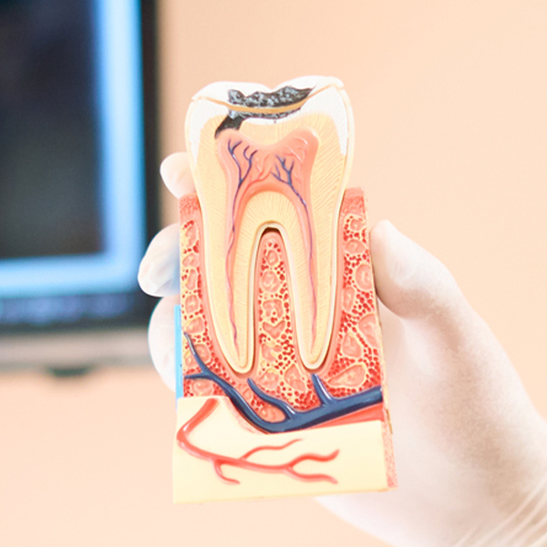 天神・福岡市中央区のなるべく神経を抜かない治療