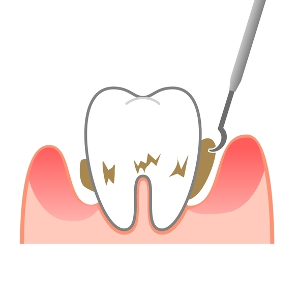天神・福岡市中央区の歯周病の治療