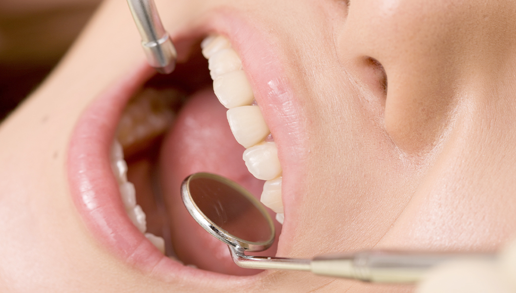 天神・福岡市中央区のなるべく神経を抜かない治療