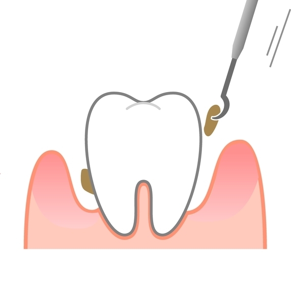 天神・福岡市中央区の歯周病の治療
